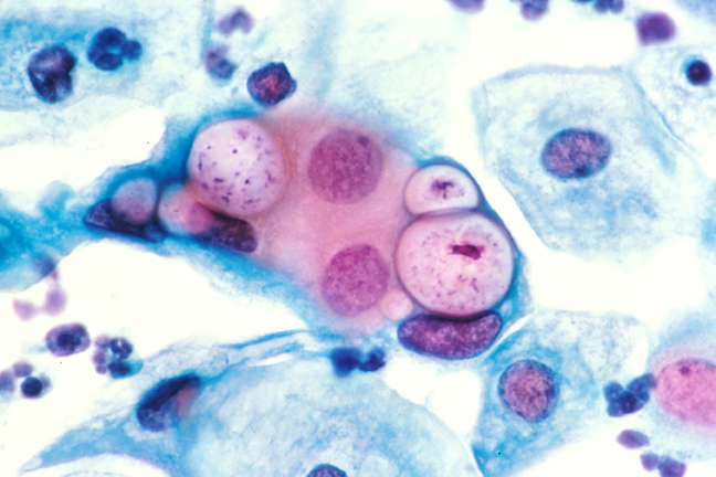 Chlamydia is the most common reportable STI in the United States.